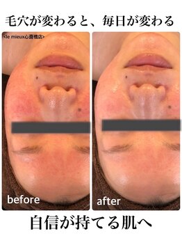 ル ミュー(le mieux)/剥離しないハーブピーリング