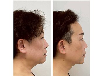 ハリ ヴァカンス(Hari Vacances)/ビフォーアフター