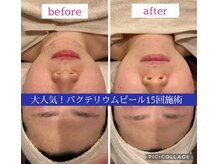 リラ(Rira)/《陶器肌・毛穴レス》施術結果