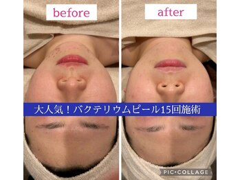 リラ(Rira)/《陶器肌・毛穴レス》施術結果