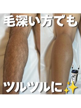 カナウ(KANAU)の写真/【全身脱毛（vio込）を8,900円で体験】面倒くさいカミソリを卒業◎メンズの剛毛も完璧にツルツルに！