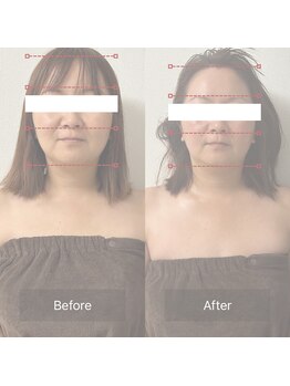 天使の艶肌 武蔵小杉店/小顔矯正 before/after 1