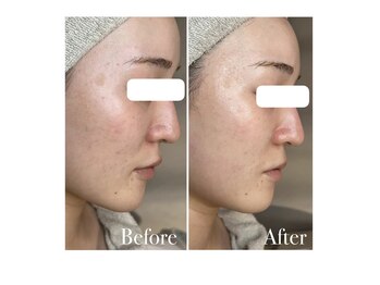 ベルティーク(BELTHEQUE)/肌管理/ララピール/ピーリング