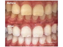 ハイティース 高田馬場店(Hi Teeth!)/医療提携セルフホワイトニング