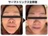 【リフトアップ人気NO.1】即攻小顔シワたるみケア!サーマトリックス全顔首