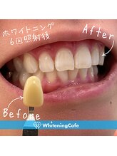 歯のホワイトニングWhiteningCafe六本木店【ホワイトニングカフェ】/ホワイトニング施術写真