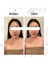 ザビューティー 麻布十番本店(The Beauty)/12Dリフト全顔打ち放題[リフト]