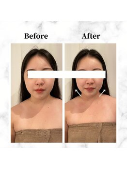 ザビューティー 麻布十番本店(The Beauty)/12Dリフト全顔打ち放題[リフト]