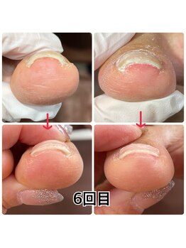 ホナ(HONA)/巻爪補正で痛み解消