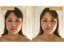 モモスパ(MOMOspa.)/頭蓋骨小顔矯正ビフォアフター
