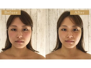 モモスパ(MOMOspa.)/頭蓋骨小顔矯正ビフォアフター