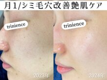 トリニエンス 新宿店(TRINIENCE)/30代/パーソナル改善ケア