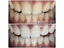 ホワイトニングルーム 横浜店(Whitening Room)/ホワイトニング/横浜