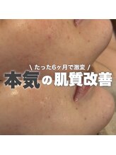 ジェノール 2nd beauty studio 姫路駅前店(JNOEL)/たった6ヶ月で激変！？肌質改善