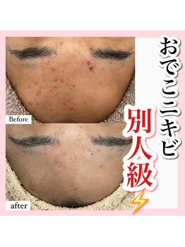 アルムダアクア 天王寺店(Aleumda AQUA)/ハーブピーリング/大阪/天王寺