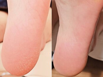 チカネイルミライ(Chika Nail ☆MIRAI★)の写真/足先まで手を抜かない！ふとした瞬間に見える足元にも彩りを♪さらに角質ケアをしてつるつるの足裏に☆