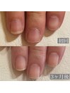 30代　噛み爪