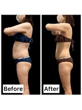 クールヴィラ(Cool Villa)/腹部4カップ×4回＋電磁パルス