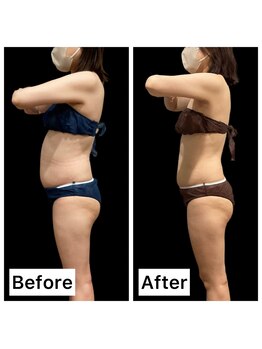 クールヴィラ(Cool Villa)/腹部4カップ×4回+電磁パルス