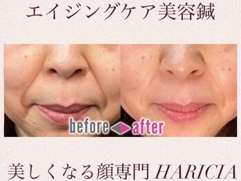 ハリシア(HARICIA)/劇的ビフォーアフター