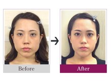 ビコツゼロ 心斎橋(BIKOTSU ZERO)/小顔・エラ張り・むくみ