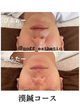 ノフ 恵比寿(noff)/効果)漢鍼 bf→af