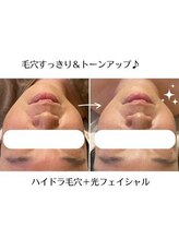 かれん/ハイドラ毛穴＋光フェイシャル