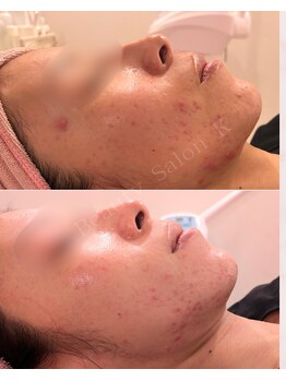 ケイ(K)/《防府》ハーブピーリング専門店