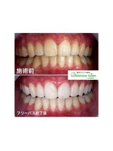ホワイトニングサロン 名古屋駅店/【ホワイトニング施術例】