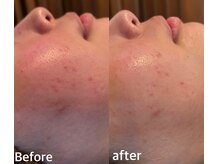 ボヌールデソワ(Bonheur de Soi)/ハーブピーリング/肌ケア/毛穴