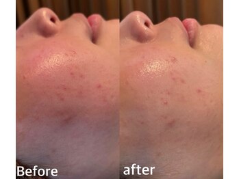 ボヌールデソワ(Bonheur de Soi)/ハーブピーリング/肌ケア/毛穴