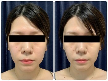 ロメリア(Roemeria)/お客様Before After