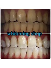 ホワイトニングショップ 日進店/Before After日進ホワイトニング