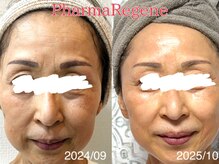 レイネ(REINE)/ファーマリジェネ深層美肌