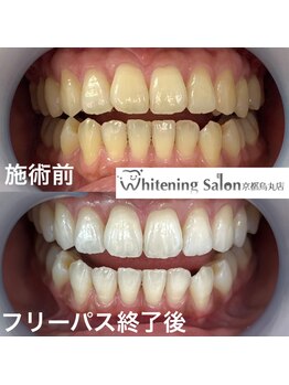 ホワイトニングサロン 京都烏丸店/ホワイトニング施術例