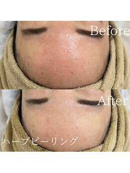 TD 清洲店/ハーブピーリング