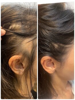 長寿鍼灸院 長寿整骨院/頭皮のビフォーアフター