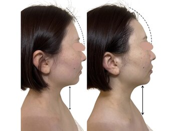 リフテグレース(LIFTE Grace)/オーダーメイドケア