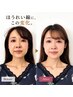 ほうれい線・フェイスラインのもたつきスッキリ【小顔矯正×身体矯正】75分
