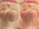 モテキ 表参道店(MoTeKi)の写真/【ハイドロで肌悩みをケア】ハーブピーリングとの併用でＷ効果◎毛穴の黒ずみ/開き/ニキビでお悩みの方に！