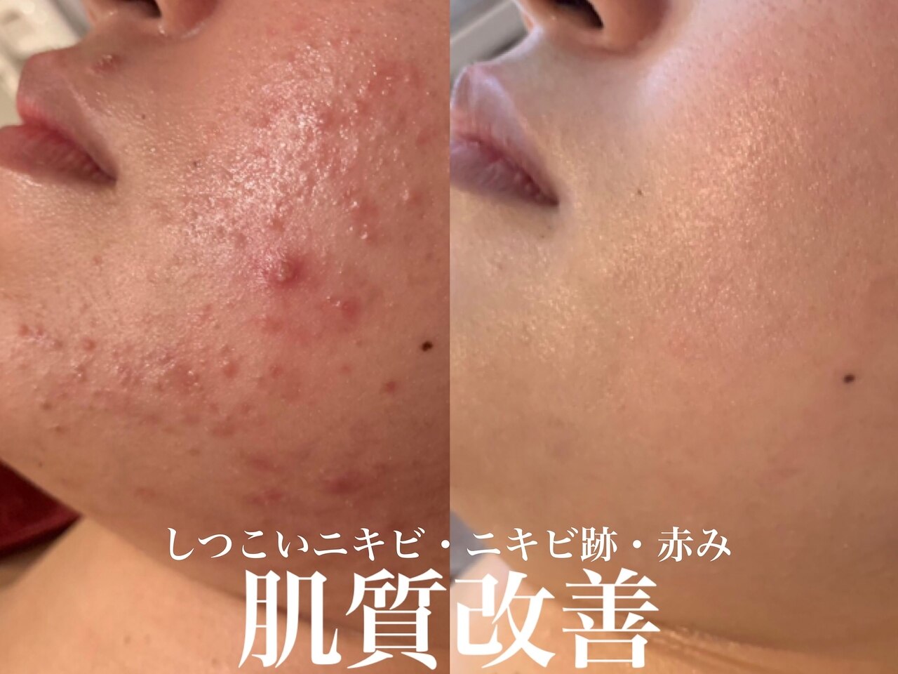 REVI ハーブピーリング 10回 REVIハーブピーリングで、 毛穴の黒ずみやザラつきを解消し