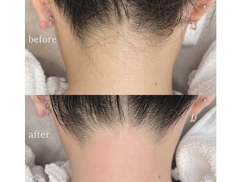 ポアラ(POARA)/毛穴/ワックス脱毛