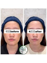 キュープ 相模原淵野辺店(Qpu)/たった4回で人生で1番小さな顔に