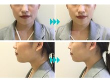 コルギ専門店 マキシフォート 栄店(Maxifort)/フェイスランすっきり！