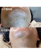 アルト(ALTO)/ヒゲ脱毛5回目の効果