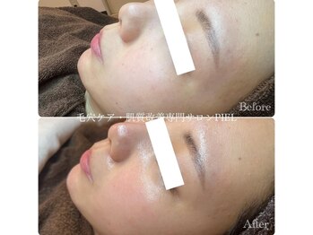 ピエル 北千住店(PIEL)/ピーリングでお肌トーンアップ