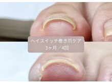 ル リアン 北浦和(le lien)の雰囲気（ジェルを塗るだけの巻き爪ケア！カラーも同時に楽しめます♪）