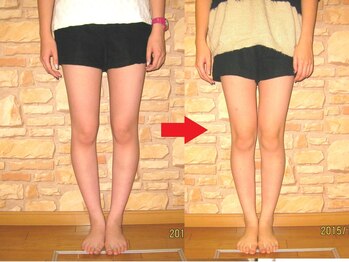 チャラク(charaku)/【20代I様：O脚矯正・骨盤矯正】