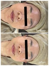 ジャスミン(Jasmin)/臍帯血幹細胞×NMN×AC-11