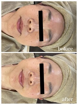 ジャスミン(Jasmin)/臍帯血幹細胞×NMN×AC-11